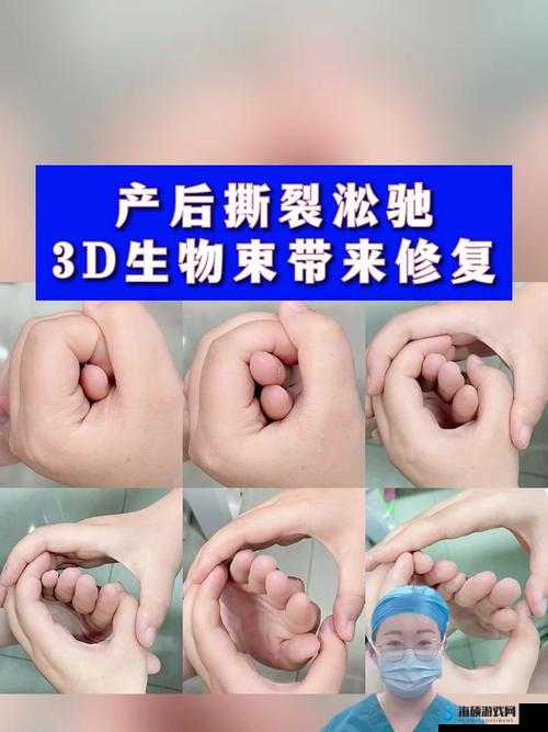 3d 生物束带紧缩术能维持几年：相关因素与效果分析